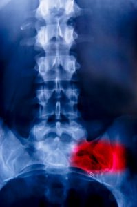 Spine Injury Attorneys San Diego